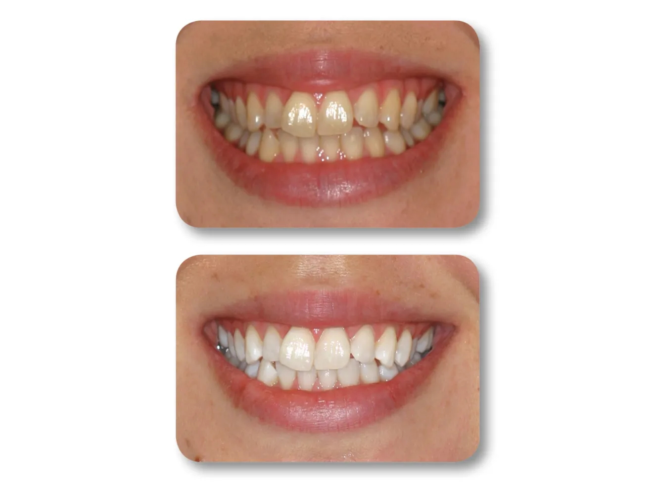 A dental aligner is placed over a set of teeth.